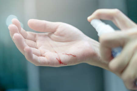 Close up wound in hand and First aid using by alcohol spray in home basic germ preventionの写真素材