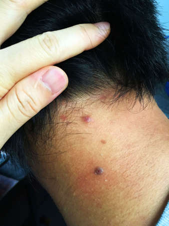 Acne and mole on the neck of Asian man