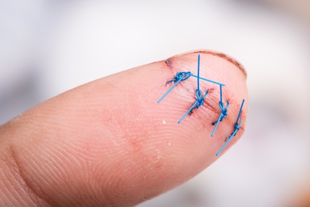 closeup wound with surgical stitchの写真素材