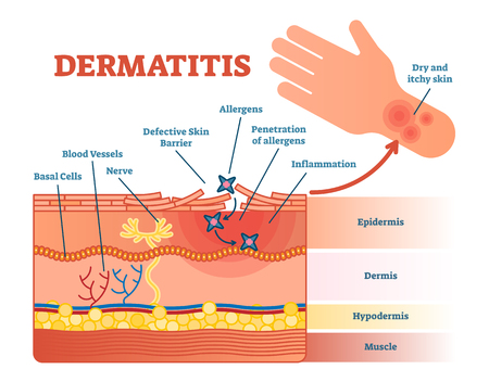 Dermatitis flat vector illustration diagram with skin layers and allergen movement. Educational medical information.のイラスト素材