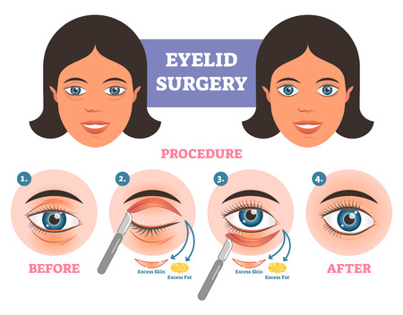 Eyelid surgery procedure before  after illuatration with main steps. Excess skin and fat removal plastic surgery.のイラスト素材
