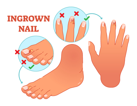 Ingrown nail medical vector illustration with foot and hand fingers.のイラスト素材