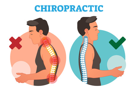 Chiropractic conceptual vector illustration with back bone curvature. Healthy and deformed.のイラスト素材