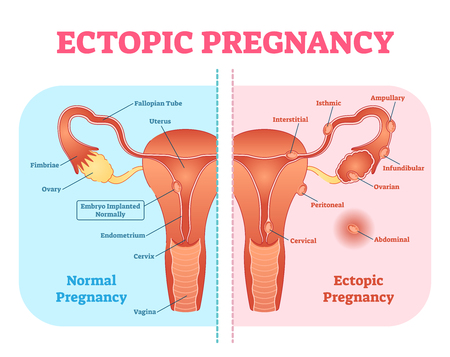 Ectopic Pregnancy or Tubal pregnancy medical diagram with female reproductive system and various embryo attachment locations. Gynecological pregnancy information.のイラスト素材