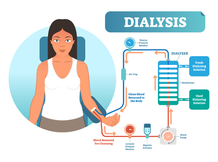 Dialysis medical procedure system vector illustration diagram. Filtering blood in case of kidney malfunction. Clinic procedure technical equipment scheme.のイラスト素材