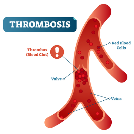 Thrombosis medical vector illustration cross section diagram, unhealthy blood vessel circulatory system disease. Blocked red blood cells flow.のイラスト素材