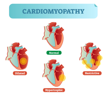 Cardiomyopathy - human heart medical disorders cross section diagram, vector illustration examples with normal, dilated, hypertrophic and restrictive conditions. Heart muscle diseases.のイラスト素材