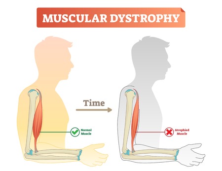 Muscular dystrophy vector illustration. Compared normal and healthy muscle versus atrophied and weak. Medical scheme with explanation how time affects bicep - normal strong muscle and degeneration.のイラスト素材