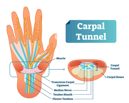 Carpal tunnel vector illustration scheme. Medical labeled diagram closeup with isolated muscle, transverse carpal ligament, median nerve, tendon sheath, flextor tendons and bones. Job and work illnessのイラスト素材