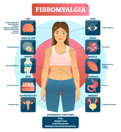 Fibromyalgia vector illustration. Diagnosis symptoms labeled diagram. Problems with jaw, joints, skin, muscle, eyes, urinary and reproductive system. Reason of fatigue.のイラスト素材