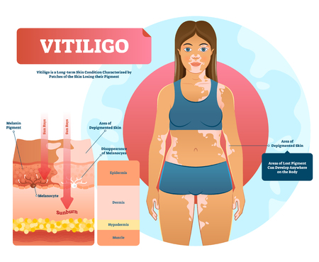 Vitiligo vector illustration. White pigment autoimmune disease with pigment loss. Skin depigmentation and genetic illness. Diagram with epidermis, dermis, hypodermis and muscle.のイラスト素材