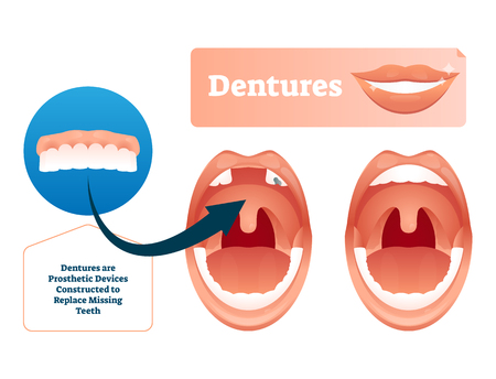 Dentures vector illustration. Medical prosthetic device for missing teeth. Human example with before and after tooth replacement technology concept. Closeup with oral mouth problem and extracted toothのイラスト素材