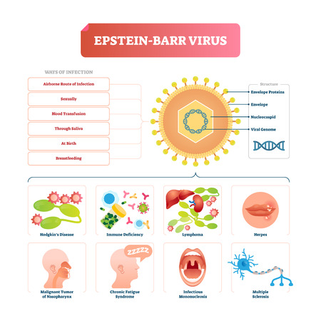 Epstein barr virus vector illustration. Labeled herpes disease explanation. Structural scheme with syndromes diagram. Infection obtaining ways examples set. Mouth and oral medical abnormal disorders.のイラスト素材