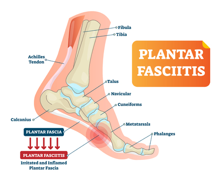 Plantar fasciitis vector illustration. Labeled human feet disorder diagram. Educational medical scheme with orthopedic leg disease. Painful plantar fascia bone inflammation and irritation infographic.のイラスト素材