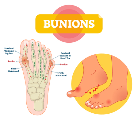 Bunions vector illustration. Labeled feet bone disorder explanation scheme. Painful toe joint condition. Orthopedics inflammation problem with deformity. Medical barefoot xray infographic diagram.のイラスト素材
