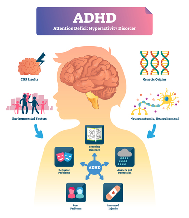 ADHD vector illustration. Labeled attention deficit hyperactivity disorder scheme. Examples with symptoms and causes. Stressful behavior explanation. Medical infographic with mind focusing illness.のイラスト素材