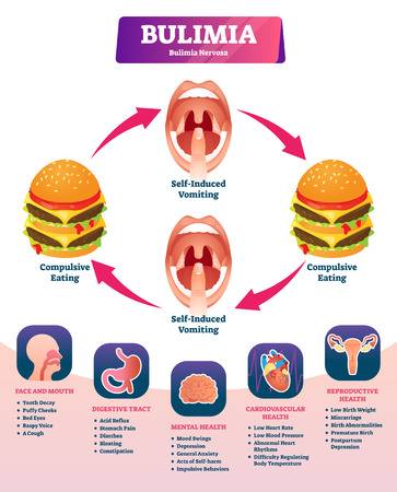 Bulimia vector illustration. Labeled self induced vomiting diagnosis scheme. Medical explanation with obesity to be slim symptoms. Eating disorder and psychological problem. Starvation addiction cycleのイラスト素材