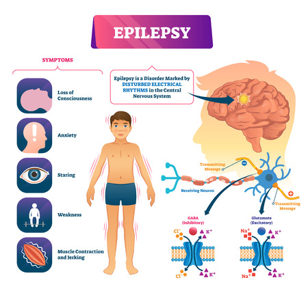 Epilepsy vector illustration. Labeled sick CNS disorder educational scheme. Patient health disease diagnosis research diagram. Problem with disturbed electrical rhythms. Anatomical symptoms and causesのイラスト素材