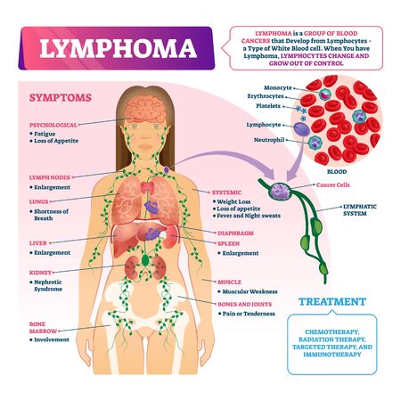 Lymphoma diagnosis vector illustration. Labeled educational blood cancer type scheme. Disease...