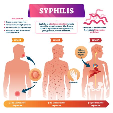 Syphilis vector illustration. Labeled sexual infection explanation scheme. Anatomical infographic with exposure stages, symptoms and risk factors. Unprotected contact disease and transmission illness.のイラスト素材