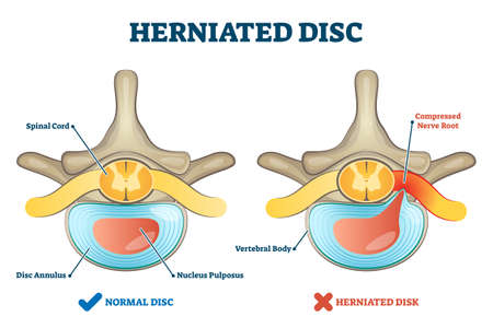 Herniated disc injury as labeled spinal pain explanation vector illustration. Medical condition with back bone trauma and nerve root compression by nucleus pulposus. Problematic example comparison.のイラスト素材