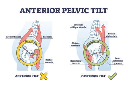 Anterior pelvic tilt model compared with posterior in labeled outline diagramのイラスト素材