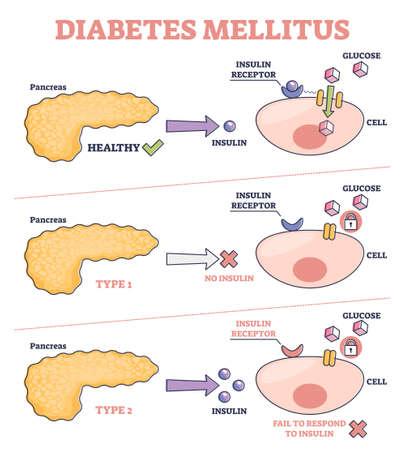 Diabetes mellitus as high blood sugar and metabolic illness outline diagramのイラスト素材