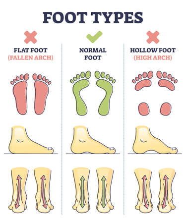 Foot types with flat, normal and hollow feet comparison in outline diagramのイラスト素材