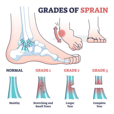 Grades of sprain as ankle or foot medical injury levels outline diagramのイラスト素材