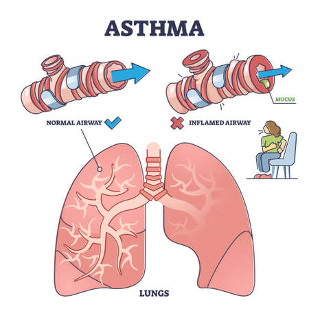 Asthma health condition compared normal and inflamed airway outline diagram