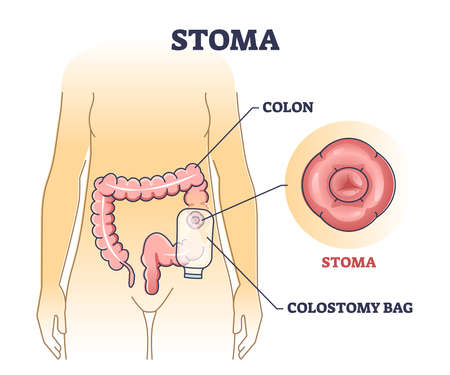 Stoma bag after colon surgery as medical patient drainage outline diagramのイラスト素材