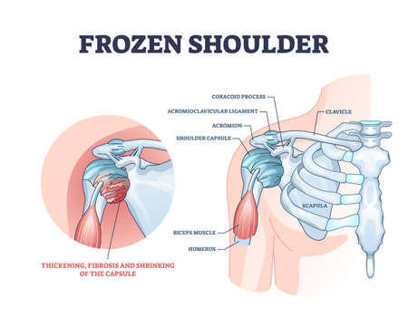 Frozen shoulder condition or adhesive capsulitis syndrome outline diagramのイラスト素材