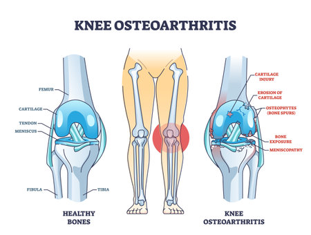 Knee osteoarthritis condition with skeletal bone degeneration outline diagramのイラスト素材