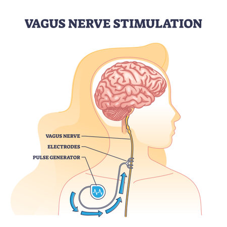 Vagus nerve stimulation as medical device implant for brain outline diagram. Labeled scheme with electric signal pulse generator or electrodes for epilepsy or depression treatment vector illustrationのイラスト素材