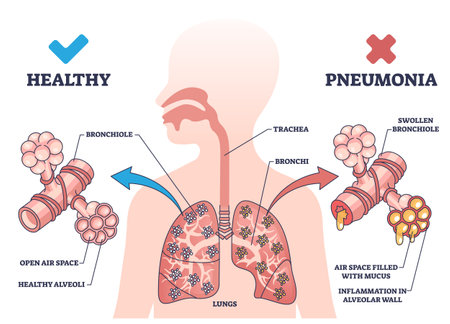Pneumonia illness medical comparison with healthy lungs outline diagram. Respiratory system problem with bronchi wall inflammation and air filled with mucus vector illustration. Bacterial infection.のイラスト素材