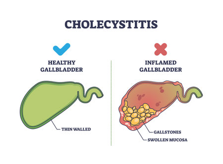 Cholecystitis as inflamed gallbladder compared with healthy outline diagram. Labeled educational scheme with swollen mucosa and gallstones in digestive tract vector illustration. Stomach disease.のイラスト素材
