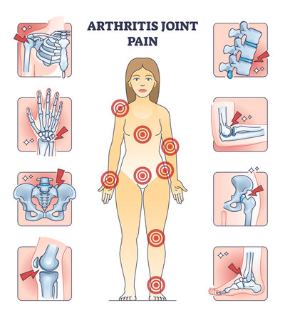 Arthritis joint pain with affected locations on human body outline diagram. Points of painful skeletal areas with anatomical chronic or acute illness vector illustration. Skeleton bone Inflammation.のイラスト素材