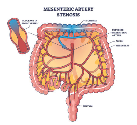 Mesenteric artery stenosis as blockage in blood vessel outline diagram. Labeled educational scheme with dangerous medical condition for abdomen and digestive tract health vector illustration.のイラスト素材