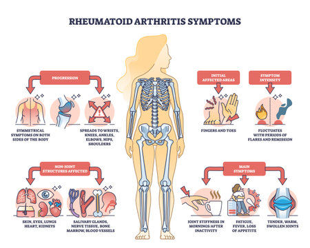 Rheumatoid arthritis symptoms with joint inflammation disease outline diagram. Labeled educational chronic illness description scheme with progression and affected body areas vector illustration.のイラスト素材