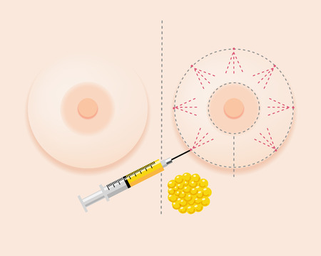 Breast fatgrant surgery image with injection and extracted fatのイラスト素材