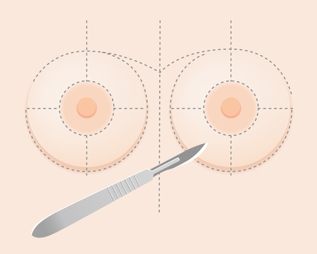 Breast implant surgery with surgical knife and guidelinesのイラスト素材