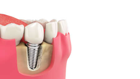 Tooth human single implant Dental concept Human teeth or dentures 3d render on white