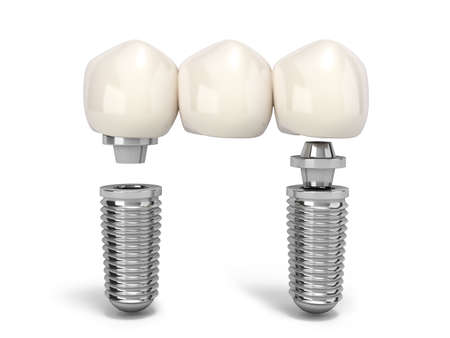 Tooth human multitooth implant Dental concept Human teeth or dentures multitooth 3d render on whiteの写真素材