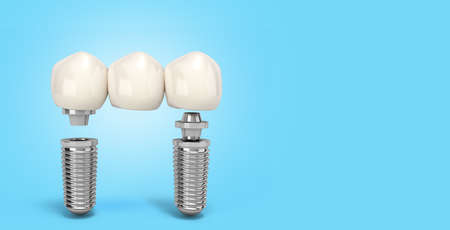 Tooth human multitooth implant Dental concept Human teeth or dentures multitooth 3d render on blue...