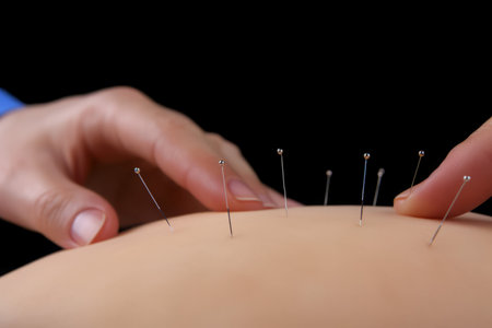 Acupuncture treatment. Asian medicine health. Generate Aiの素材