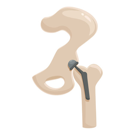 Detailed vector graphic of a hip prosthesis implanted in a femur boneのイラスト素材