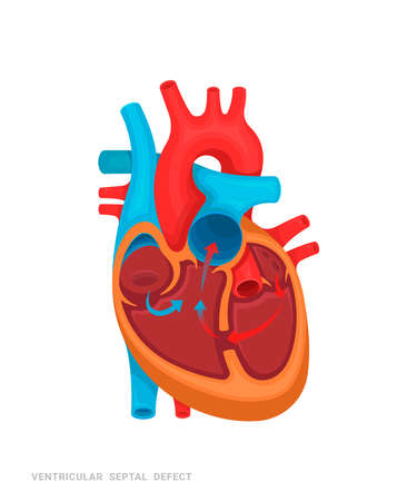 Heart defect. Ventricular septal defect. Illustration for medicine books, websites, apps. Heart disease with name.のイラスト素材