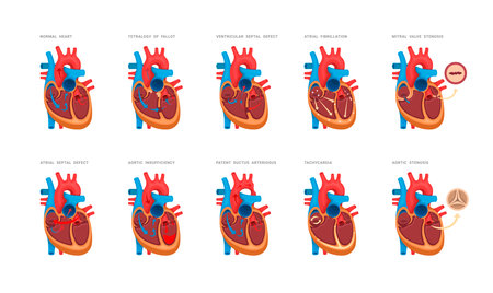 Set of heart defects. Illustrations for medicine books, websites, apps. Heart diseases with names.のイラスト素材