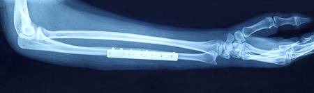 Film x-ray show fracture shaft of arm insert plate and screw for fix armâ€™s bone
