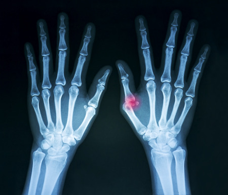 Film x-ray both human's hands and thumb crash injuryの写真素材